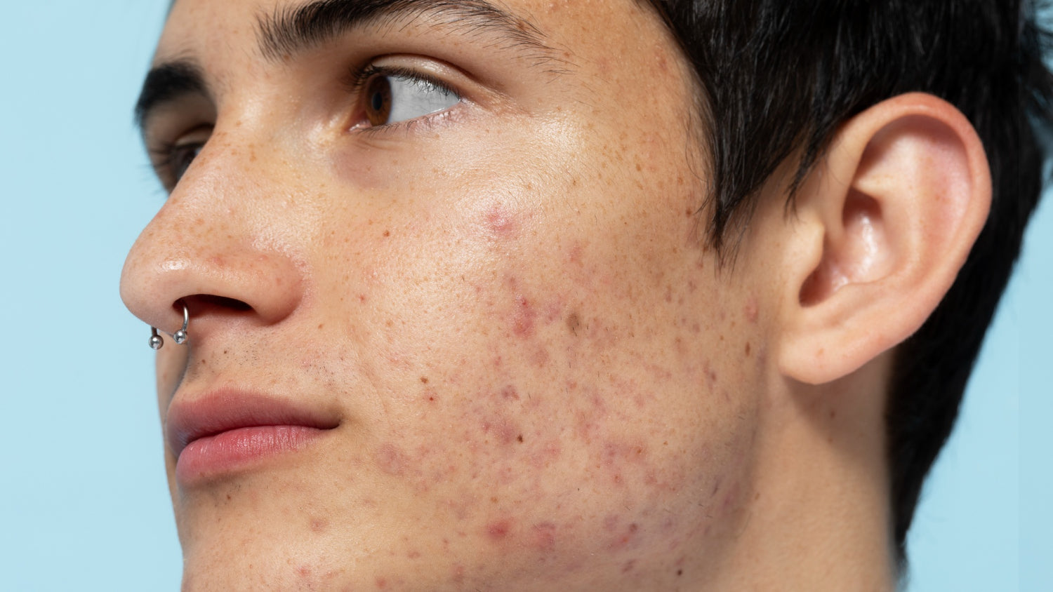 Piel con acne